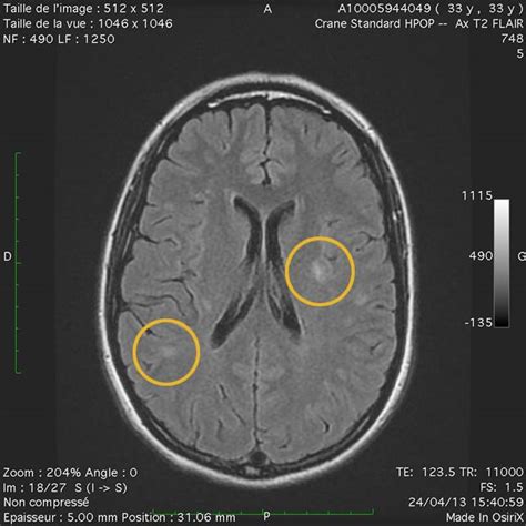 IRM montrant des lésions de sclérose en plaques