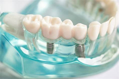 Implant dentaire