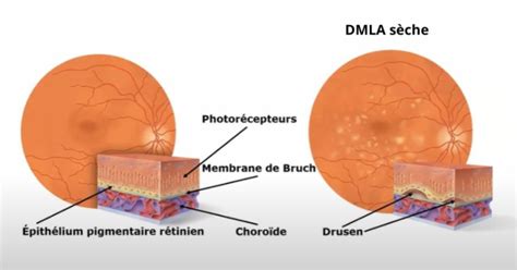 Schéma de la DMLA